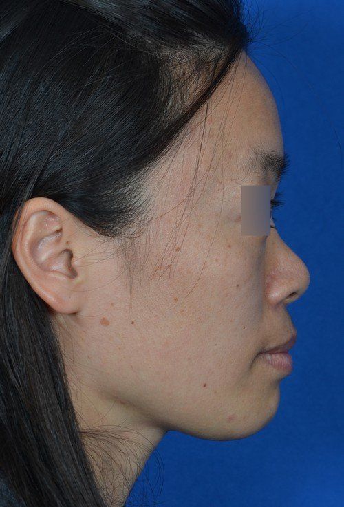 female rhinoplasty