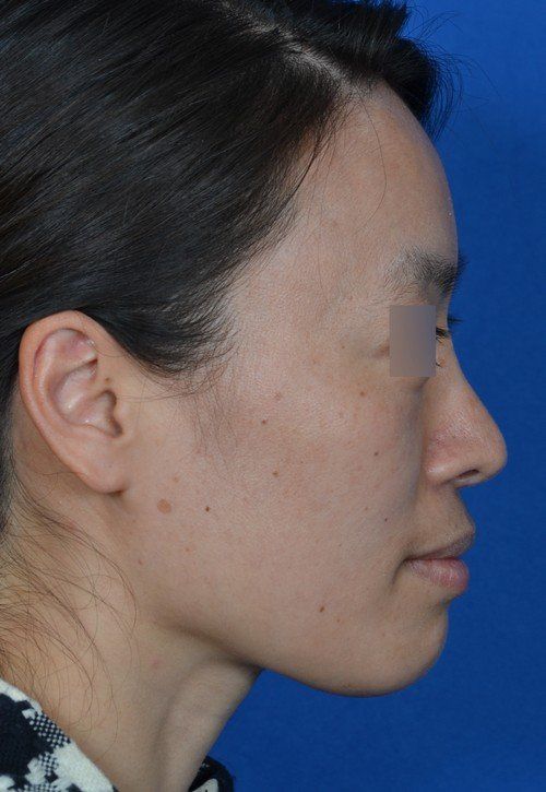 female rhinoplasty