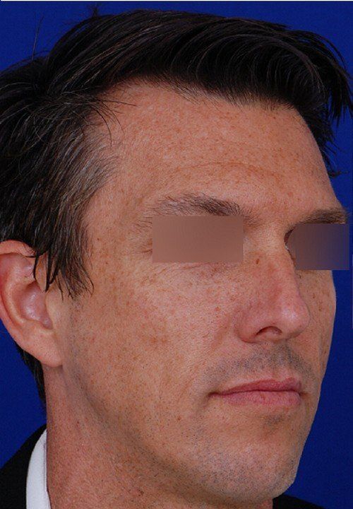 male rhinoplasty