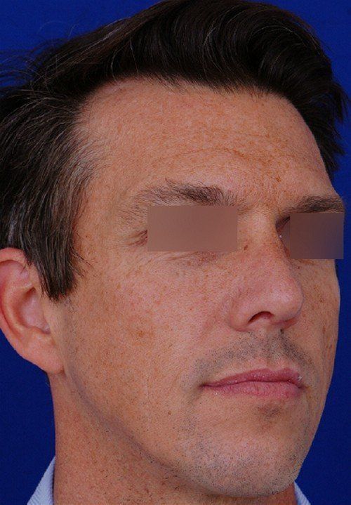male rhinoplasty