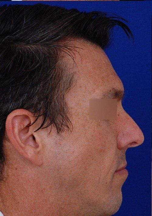 male rhinoplasty