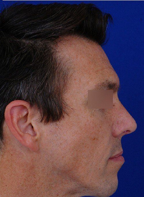 male rhinoplasty