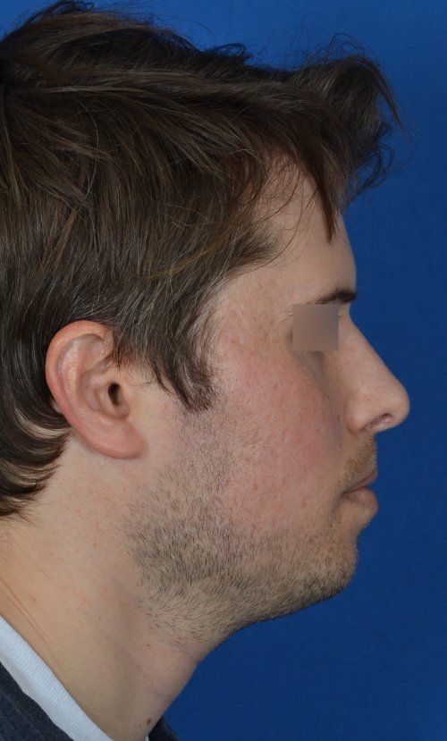 rhinoplasty before and after