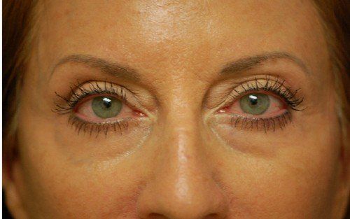 womans eyes after a chemical peel