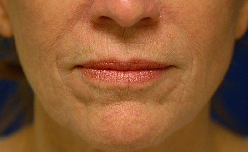 before facial peel chin