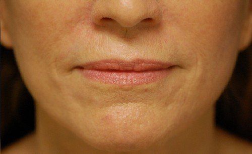 after facial peel chin