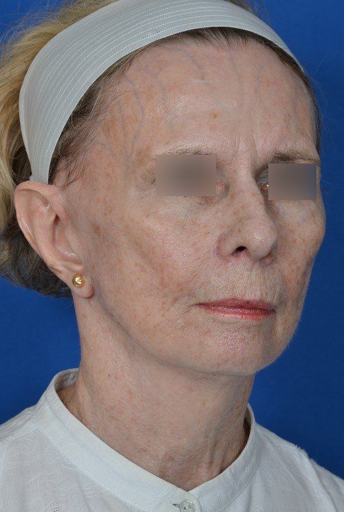 before and after facelift