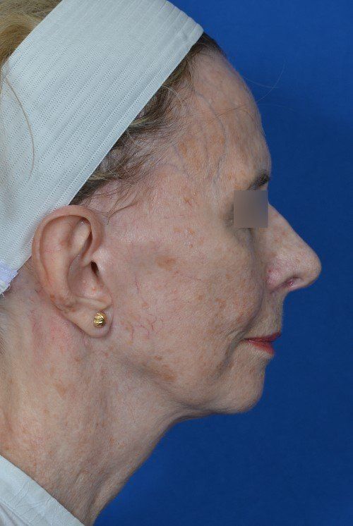 before and after facelift