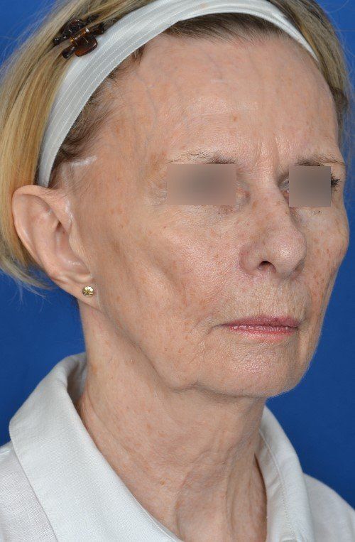 before and after facelift