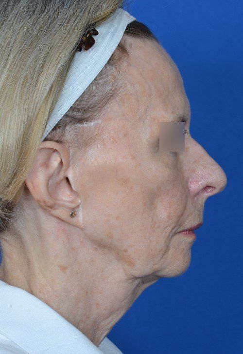 before and after facelift