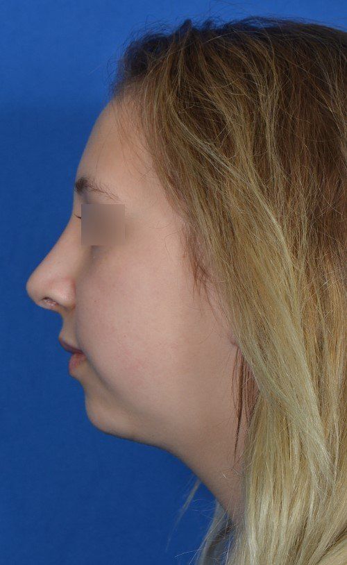 female rhinoplasty