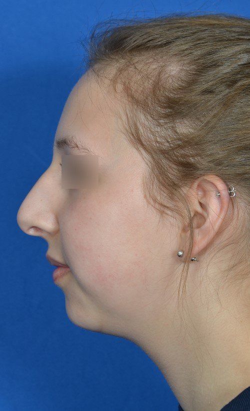 female rhinoplasty