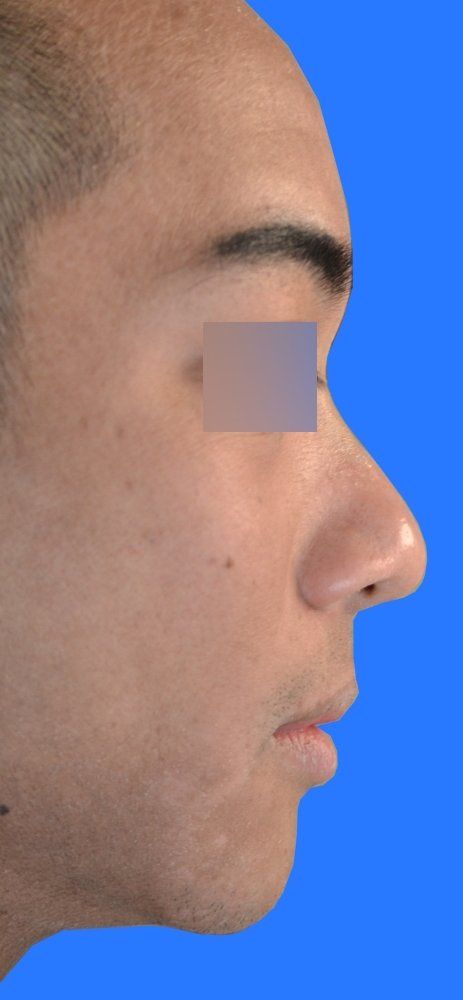 before nonsurgical rhinoplasty