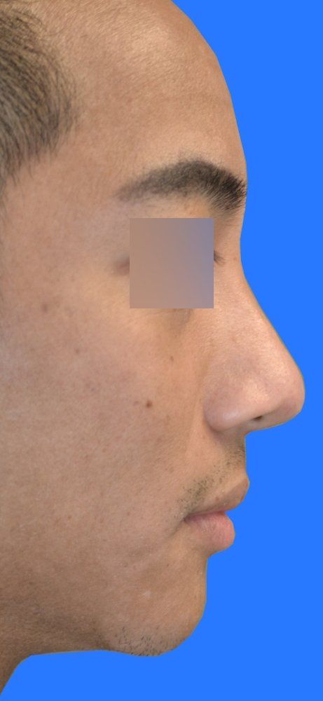 after nonsurgical rhinoplasty