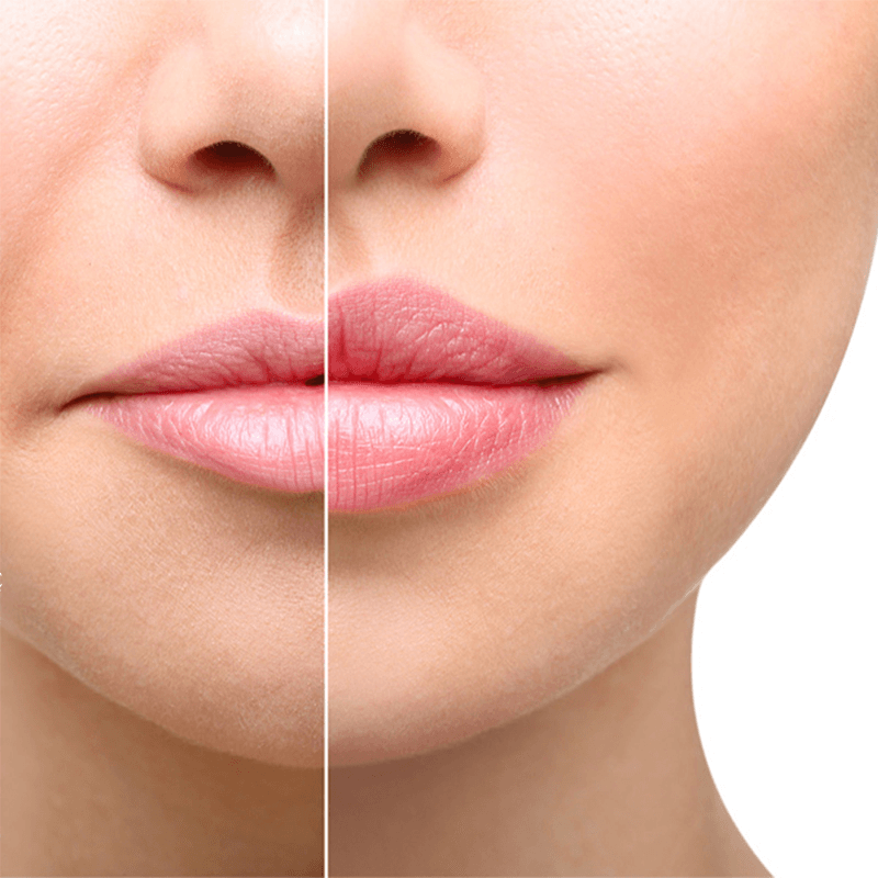 lips before and after permalip treatment