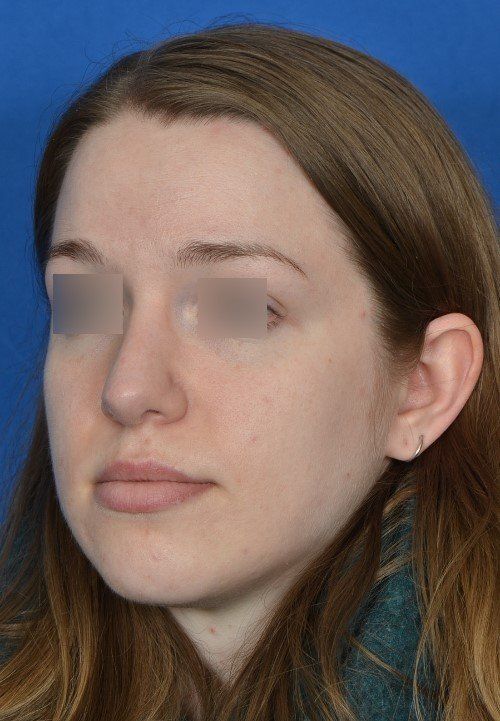 rhinoplasty before and after
