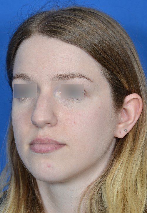 rhinoplasty before and after