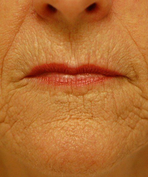 wrinkles around mouth before deep peel