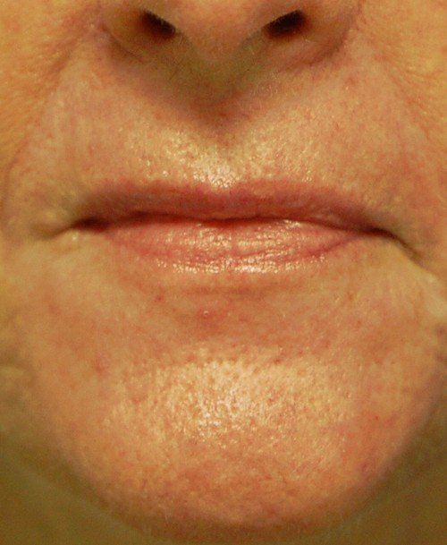 no more wrinkles around mouth after deep peel