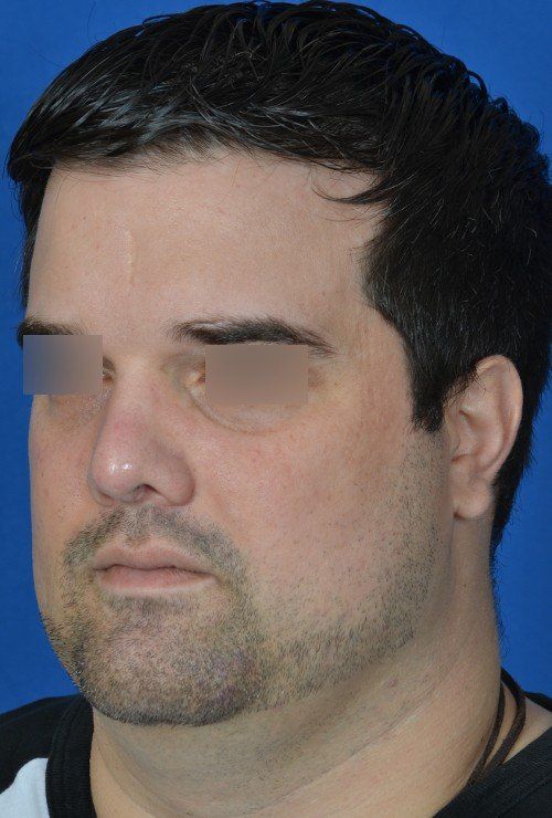 before and after rhinoplasty