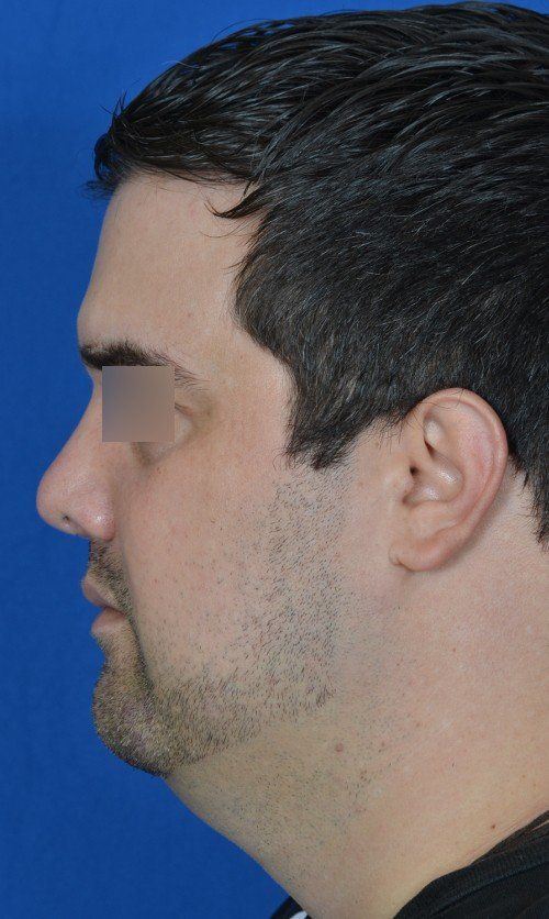 rhinoplasty before and after
