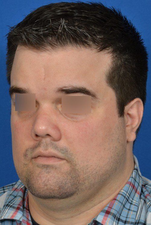 before and after rhinoplasty
