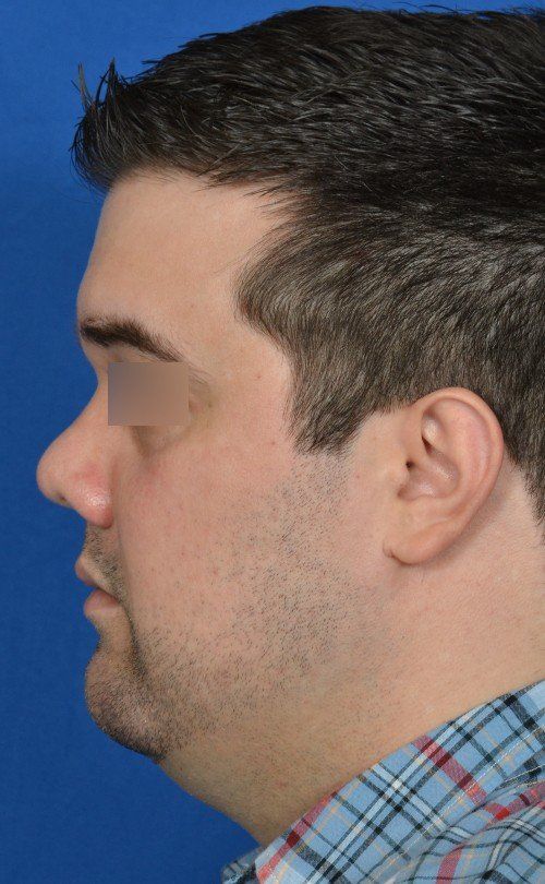 male rhinoplasty 