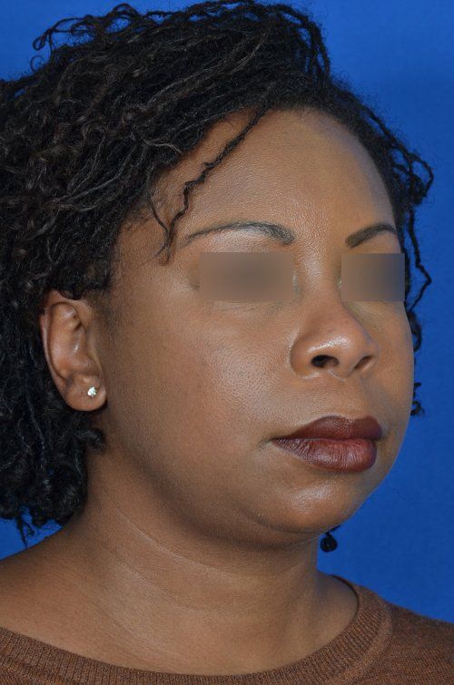 chin implant and rhinoplasty