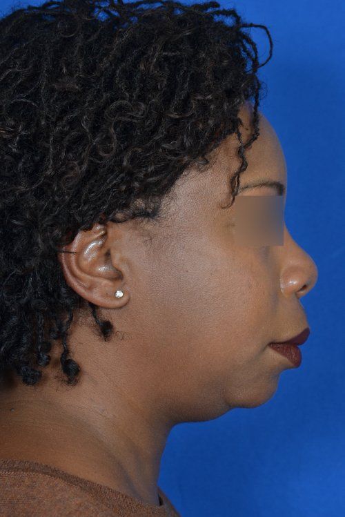chin implant and rhinoplasty