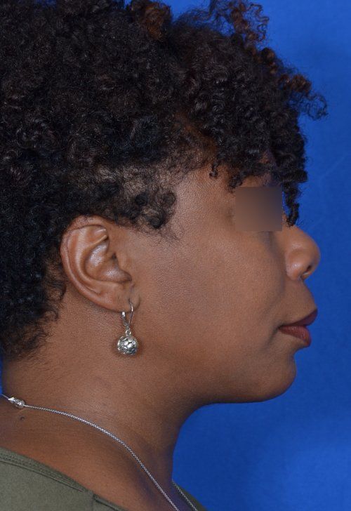 chin implant and rhinoplasty