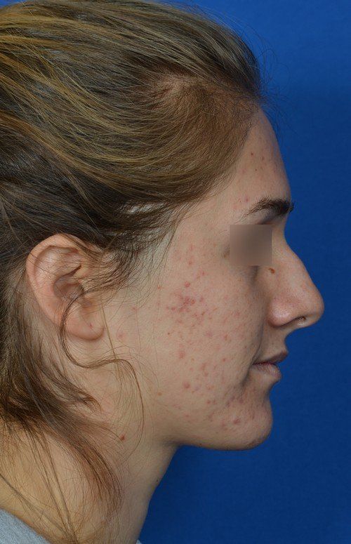 female rhinoplasty