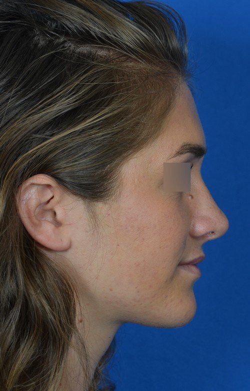 rhinoplasty before and after