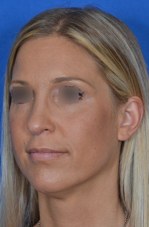 female rhinoplasty