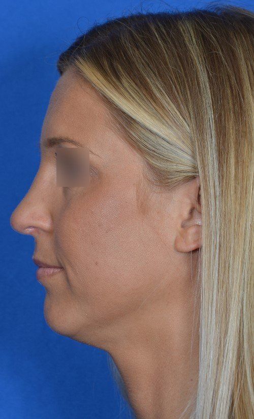 rhinoplasty before and after