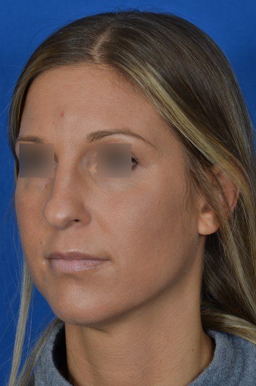 female rhinoplasty