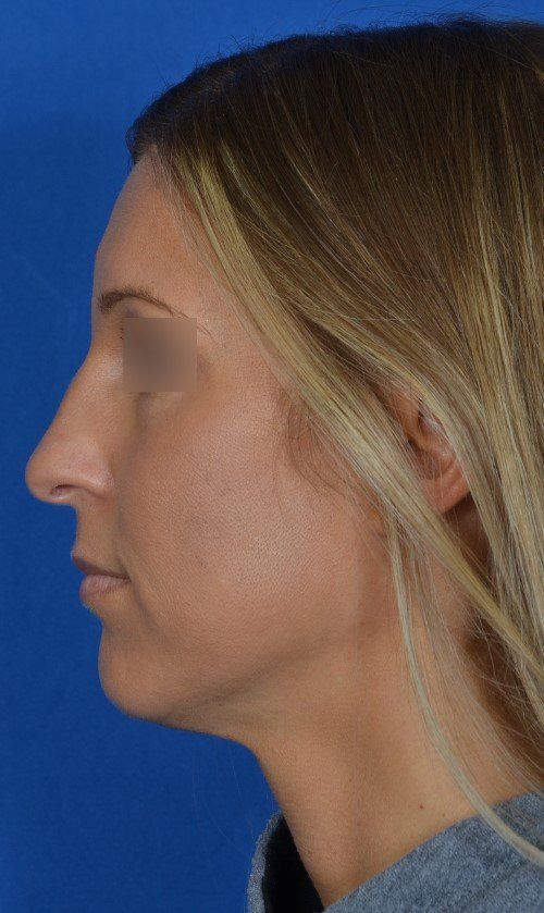 rhinoplasty before and after
