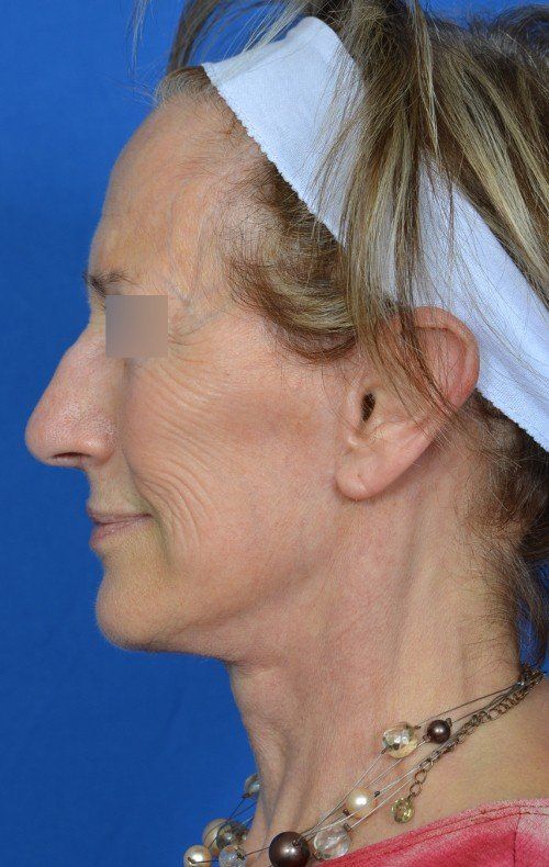 after facelift side profile of woman