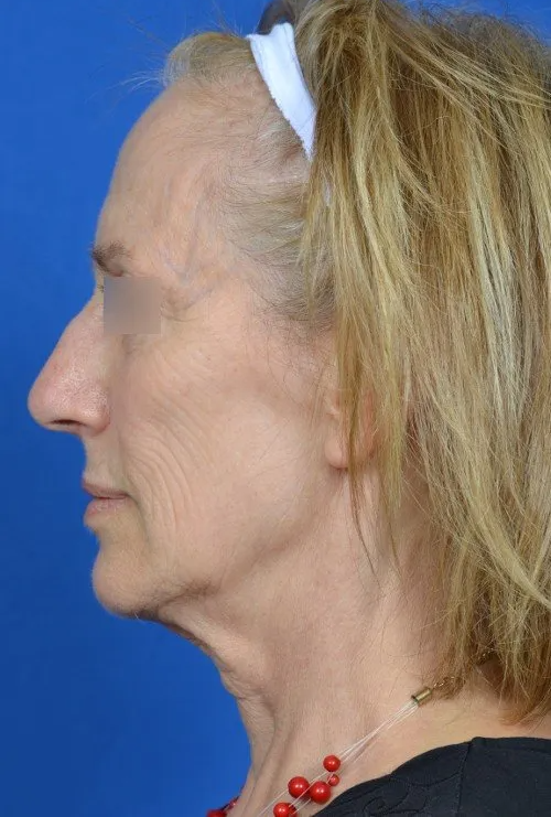 before facelift side profile of woman