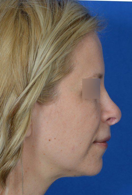 female rhinoplasty
