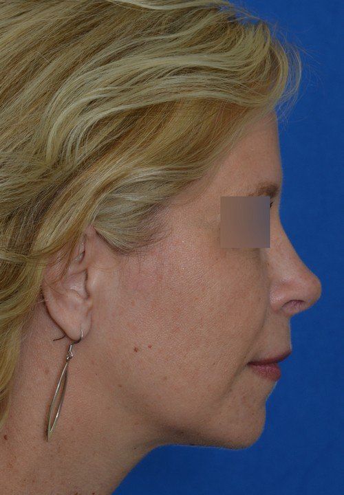 female rhinoplasty