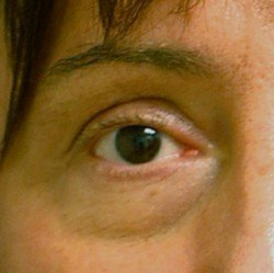 close up of mans eye before undereye surgery