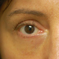 close up of mans eye after blepharoplasty