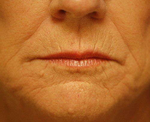 wrinkles around mouth before peel