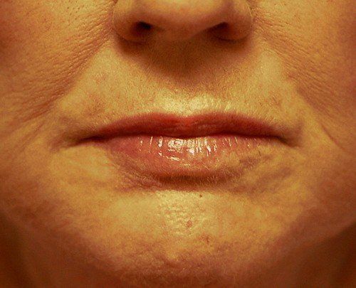 wrinkles gone after peel