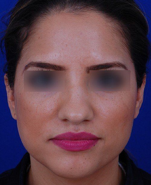 female rhinoplasty