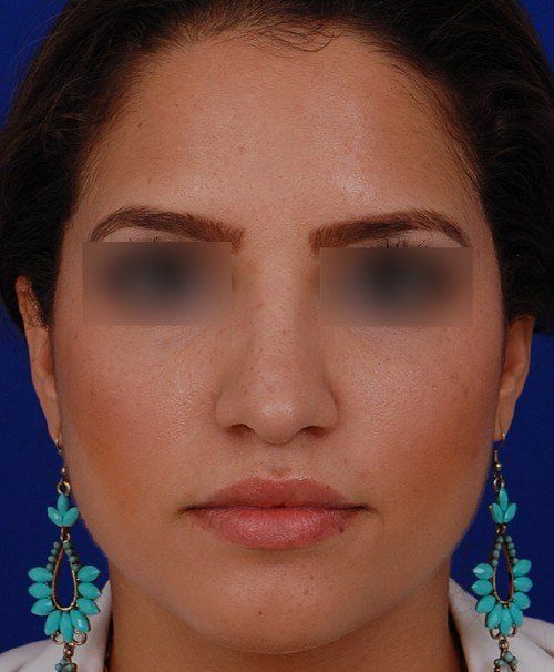 female rhinoplasty