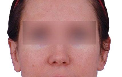 after otoplasty