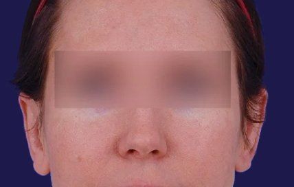 after female earlobe surgery
