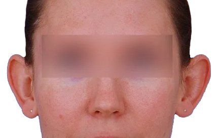 before otoplasty