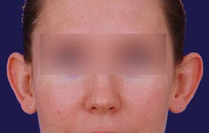before female earlobe surgery